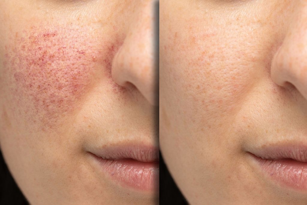 side-by-side close-up of a woman’s cheek showing visible redness on the left and clearer skin on the right