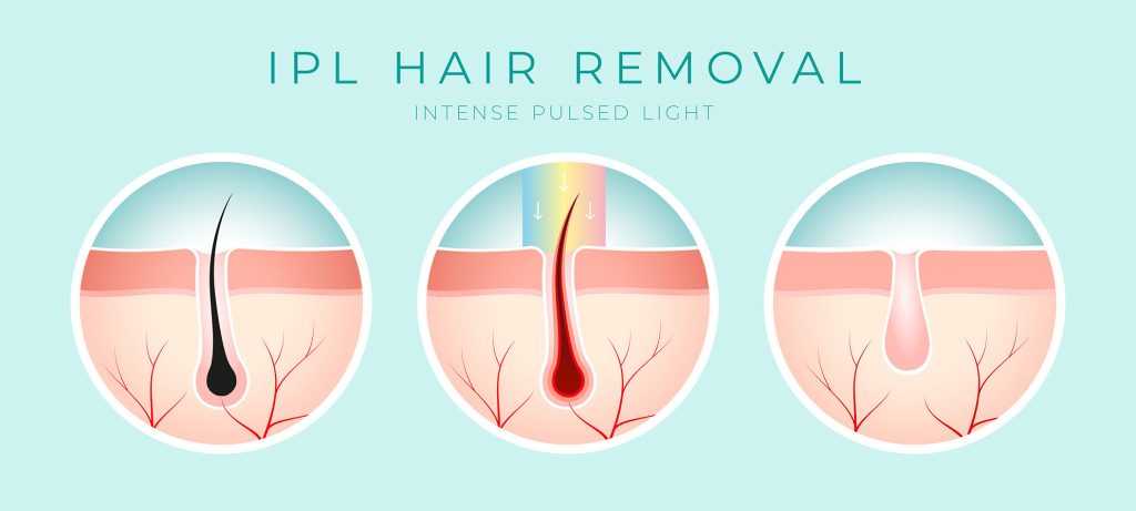 ipl hair removal process diagram illustrated diagram showing three stages of IPL hair removal on skin with labeled text “IPL Hair Removal”