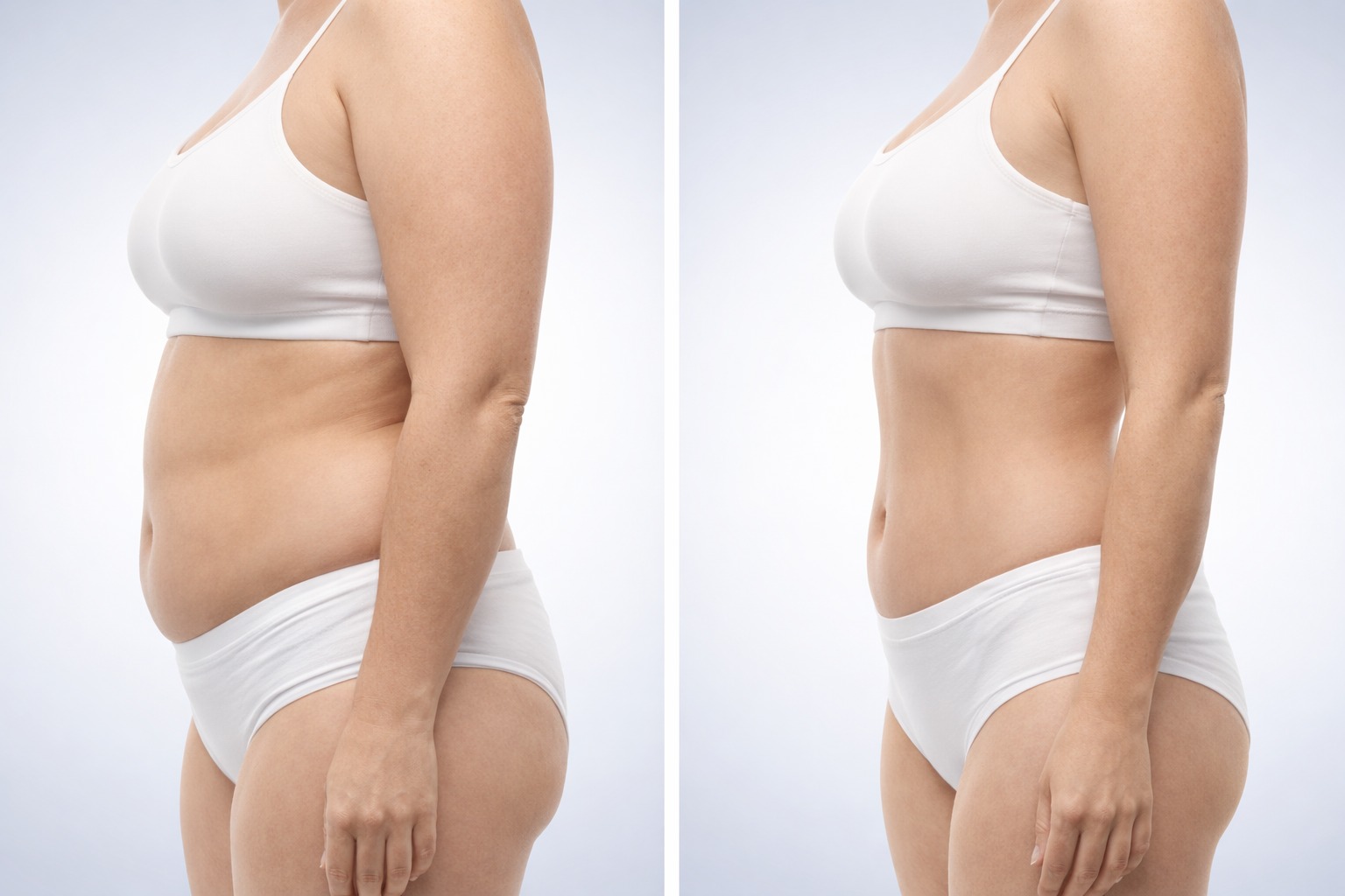 Side-by-side profile views of a person’s torso wearing white undergarments, showing differences in abdominal contour.