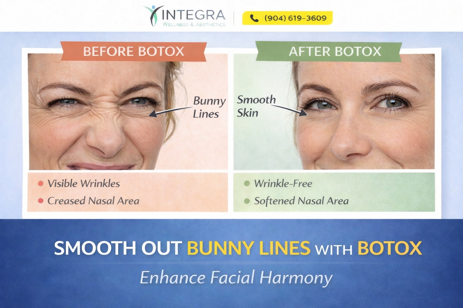 Side-by-side images showing wrinkles along the sides of the nose on the left and fewer visible lines on the right