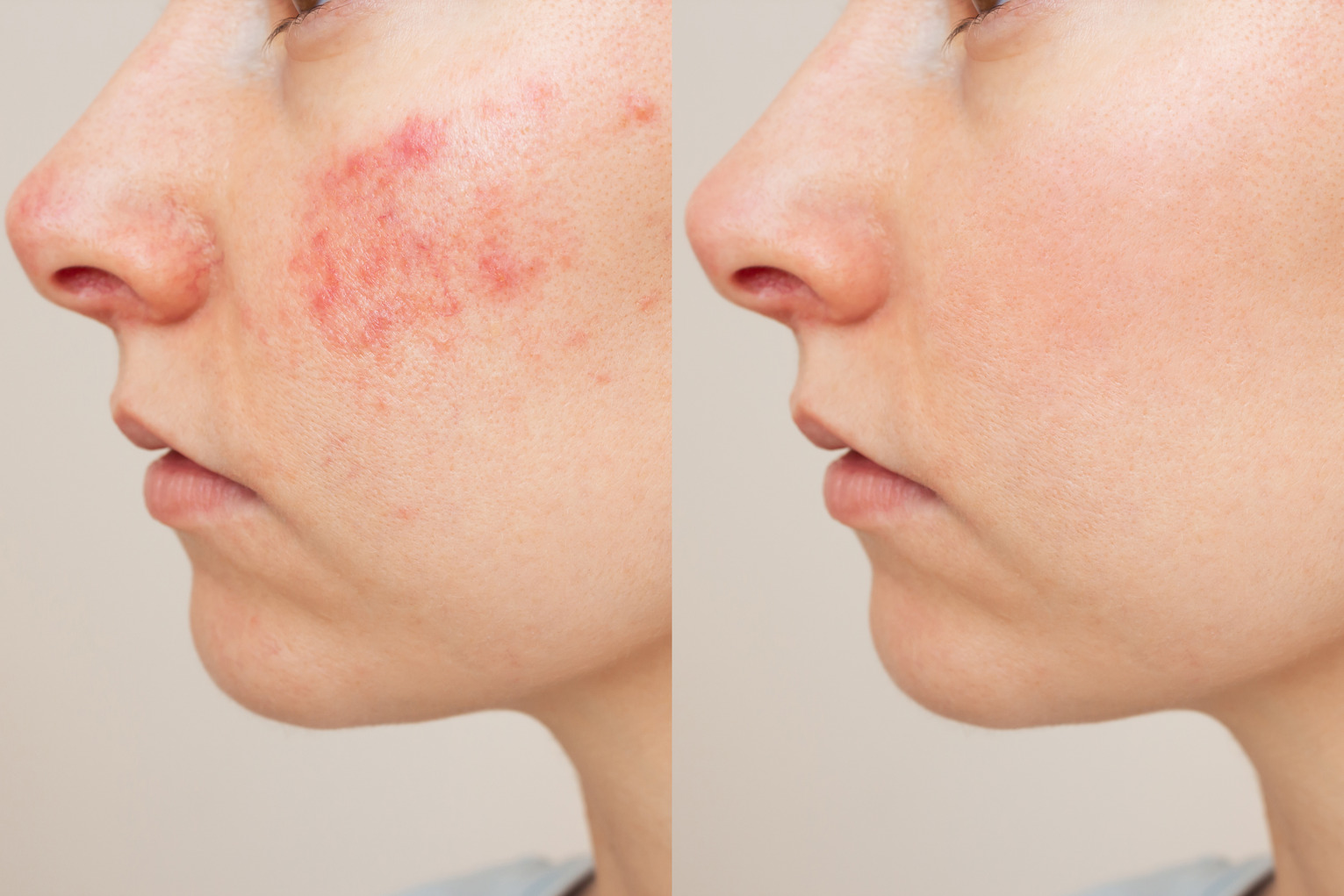 Left and right facial profile images showing differences in cheek redness and skin tone.